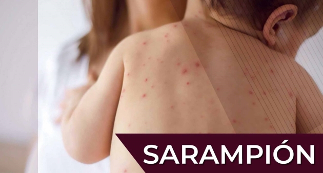 ¡Cuidado!, el sarampión es más contagioso que la COVID-19